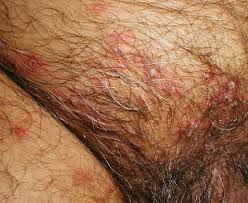 Illustration for article titled Cara Tradisional Menghilangkan Penyakit Herpes
